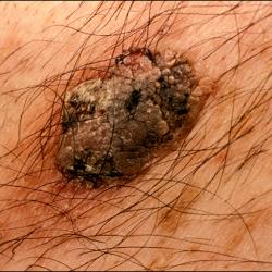 Example of skinLumpsAndBumps